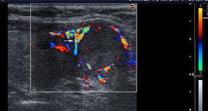 Ecografia tiroidea con Doppler color, corte transversal. Se muestra un nódulo tiroideo con patrón vascular tipo II, con vasos periféricos (flecha), en el contexto de hiperplasia nodular tiroidea.