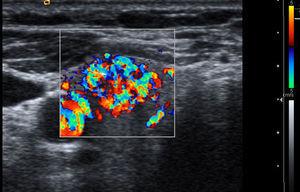 Ecografia tiroidea con Doppler color, corte transversal. Se muestra un nódulo tiroideo con patrón vascular tipo III, con vascularización central aumentada (flecha), en un nódulo tiroideo diagnosticado de carcinoma papilar.