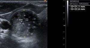 Ecografía tiroidea en modo B, corte transversal. Se muestra un nódulo tiroideo con múltiples microcalcificaciones dispersas (flecha) ocupando toda la lesión, diagnosticado de carcinoma papilar.