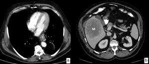 Cáncer de esófago con metástasis a distancia (cM). Imágenes axiales de TC. Lesión tumoral (T) en un paciente diagnosticado de neoplasia de tercio inferior del esófago (a) y gran masa sólida de baja atenuación (M) que corresponde a una metástasis en el lóbulo hepático derecho (b).