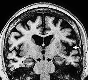 Paciente de 70 años con clínica de demencia frontotemporal variante afásica. Secuencia coronal T1 3D que muestra atrofia perisilviana asimétrica izquierda (flecha blanca) con hipocampos y estructuras del lóbulo temporal medial normales (flechas negras).
