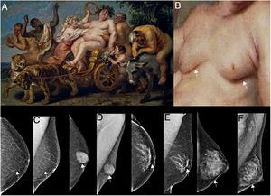 A) El triunfo de Baco. Óleo sobre lienzo de Cornelis de Vos (1636-1638), exhibido en el Museo del Prado, Madrid, España. B) Detalle en aumento del torso del modelo en donde se observa el desarrollo de ambas mamas, señalizadas con flechas blancas. C) Incidencia mamográfica craneocaudal y oblicua mediolateral izquierda en donde se observa que el volumen mamario está constituido por tejido adiposo. Diagnóstico mamográfico de lipomastia (señalizado con flechas blancas). D) Incidencia mamográfica craneocaudal y oblicua mediolateral izquierda en donde se observa que el volumen mamario está constituido por el patrón mamográfico nodular de la ginecomastia (señalado con flechas blancas). E) Incidencia mamográfica craneocaudal y oblicua mediolateral izquierda en donde se observa que el volumen mamario está constituido por patrón mamográfico detrítico de la ginecomastia (señalizado con flechas blancas). F) Incidencia mamográfica craneocaudal y oblicua mediolateral izquierda en donde se observa que el volumen mamario está constituido por el patrón glandular difuso de la ginecomastia (señalizado con flechas blancas).