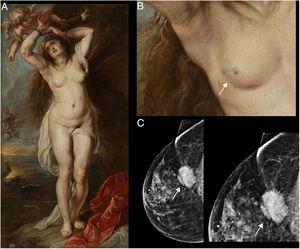 A) Andrómeda encadenada, de Peter Paul Rubens (1634), pintura sobre tela exhibida en la Biblioteca Museo Víctor Balaguer. B) Detalle de la mama derecha representada en el óleo, en donde se observa en el cuadrante inferoexterno una retracción de la piel (señalizado con una flecha blanca). C) Mamografía. Incidencia craneocaudal, patrón glandular ACR B en el sector externo, plano posterior, donde se visualiza una imagen nodular densa irregular espiculada que retrae el músculo pectoral y la piel (señalizado con una flecha blanca) y ampliación magnificada de la imagen nodular señalizada con una flecha blanca.