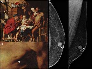 A) El sátiro y el campesino, de Jacob Jordaens (1620-1621). Se trata de un óleo sobre roble, del museo Alte Pinakothek de Múnich, Alemania. B) Ampliación del tórax del sátiro donde se observa una retracción en el sector externo paraareolar de la mama izquierda señalizado con una flecha blanca. C) Incidencia mamográfica craneocaudal y oblicua mediolateral izquierda donde se observa en el sector retroareolar una imagen nodular densa, irregular, espiculada, con microcalcificaciones asociadas y retracción de la piel (señalizado con una flecha blanca).