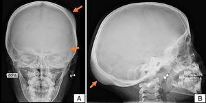 Radiografías de cráneo en proyecciones anteroposterior (A) y lateral (B). Se observan áreas de mayor grosor óseo y disminución de la densidad en huesos frontal y occipital (flechas).
