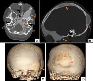 Tomografía computarizada craneofacial axial (A), reconstrucción sagital (B) y 3D (C y D), en la que se confirma y se definen las lesiones de densidad homogénea en vidrio esmerilado en los huesos frontal, occipital y esfenoidal izquierdos, características de la displasia fibrosa poliostótica.
