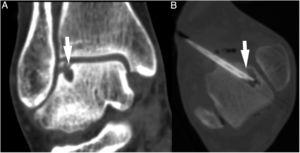A) Reconstrucción coronal de tomografía computarizada (TC) con lesión osteocondral talar (flecha). B) Se realizó inyección intralesional guiada con TC de plasma rico en plaquetas (flecha).