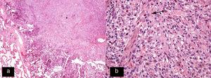 Imagen histológica teñida con hematoxilina-eosina (H-E 20x). A) Nódulo celular de morfología estrellada (asterisco). B) Imagen histológica a mayor aumento (H-E 200x) que muestra la composición de esta lesión predominantemente por células de Langerhans (flecha) en combinación con eosinófilos y otras células inflamatorias.