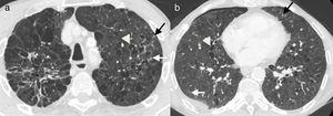 Varón de 55 años, fumador activo, con dolor torácico agudo. A y B) Imágenes axiales de tomografía computarizada de tórax. Pequeños nódulos sólidos (flechas negras), algunos de ellos cavitados (flechas blancas), y múltiples quistes de morfología y tamaño variables (cabezas de flecha), asociados a enfisema y áreas de fibrosis (asterisco). Existe un pequeño neumotórax derecho (B), el cual explica los síntomas clínicos.