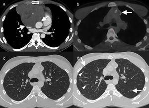 Varón de 22 años, no fumador, con antecedentes de seminoma con extenso compromiso mediastínico. Imagen axial de tomografía computarizada con contraste. A) Masa sólida en el mediastino anterior (asterisco), con pérdida de planos grasos de separación con las estructuras vasculares (flechas), que sugieren invasión vascular. El paciente presentó remisión de la enfermedad tras quimioterapia, como se evidencia en la imagen axial de tomografía por emisión de positrones-tomografía computarizada (PET-TC) (B). La masa ha disminuido de tamaño y muestra calcificación parcial, sin actividad metabólica residual (flecha). Imagen axial en ventana de pulmón (C) que muestra parénquima normal. TC de control, 12 meses después de finalizar la quimioterapia (D) que muestra múltiples nódulos pulmonares sólidos (cabezas de flecha) y cavitados (“signo de Cheerio”) (flechas). El diagnóstico histológico confirma agregados histiocíticos y células de Langerhans (fig. 2) en este paciente con histiocitosis de células de Langerhans.
