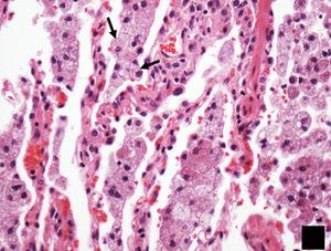 Imagen histológica, teñida con hematoxilina-eosina (H-E 100x) y característica de la afectación pulmonar por enfermedad de Erdheim-Chester que evidencia espacios alveolares repletos por histiocitos espumosos (flechas).