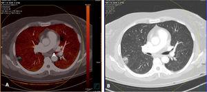Paciente con COVID-19, que presentaba varias lesiones de alta atenuación pulmonares. Tomografía computarizada de doble energía. Angio-TC (doble energía) donde no se apreciaron datos de tromboembolismo pulmonar (TEP). A) Imagen de mapa PBV (Pulmonary Blood Volume) donde no se aprecian defectos de perfusión que fueran característicos de TEP, mostrando una perfusión homogénea del parénquima pulmonar. B) Ventana de pulmón que muestra una de las lesiones pulmonares con signo de halo invertido.