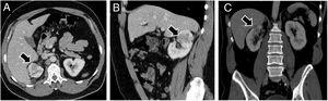 Las imágenes por TC en fase venosa con contraste (A, proyección axial; B, sagital; C, coronal) obtenidas después de la resección quirúrgica de la lesión renal muestran una lesión focal hipoatenuada (flechas) junto al tejido cicatricial renal, con características similares a la resecada.