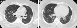 A y B) Imágenes de tomografía computarizada de tórax de un paciente de 30 años con COVID-19 con opacidades en vidrio esmerilado bilaterales en una distribución periférica.
