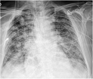 Radiografía de tórax positiva para neumonía COVID-19. Hombre de 78 años con opacidades parcheadas en ambos campos pulmonares.
