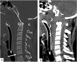 Valoración de la alineación de la columna en una TC cervical sin CIV en paciente atropellado. Reconstrucciones sagitales. A) Ventana de hueso. Aumento de la distancia basión-apófisis odontoides con desplazamiento anterior y en el eje craneocaudal de la base del cráneo sobre la columna o tipo i y ii de la clasificación de Traynelis (doble flecha). Retrolistesis traumática de C7 sobre D1 (flecha). El aumento del espacio interespinoso (doble flecha punteada) sugiere lesión del complejo ligamentario posterior. B) Ventana de partes blandas. El extenso hematoma prevertebral (cabezas de flecha) con extensión intrarraquídea sugiere lesión de la columna cervical. En algunos pacientes puede ser el único signo de lesión vertebral.