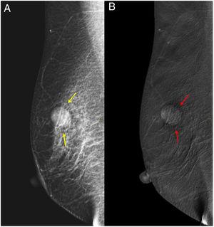 Mujer de 62 años que acude por tumoración palpable en la mama derecha. A) En la proyección oblicua mediolateral de la imagen mamográfica de baja energía no contrastada se identifica un nódulo oval de borde bien delimitado (flechas amarillas). B) En la imagen de mamografía recombinada poscontraste, el nódulo visto presenta realce moderado y homogéneo (flechas rojas). Ante los hallazgos, se asignó la categoría BI-RADS 4, y se realizó biopsia con resultado de carcinoma infiltrante.