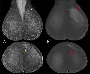 Mamografía bilateral con contraste. Mujer de 54 años que acude por masa palpable en el cuadrante superoexterno de la mama izquierda. (A) En las imágenes de mamografía de baja energía no contrastadas, análogas a la mamografía estándar, se observa una asimetría sutil en el CSE de la mama izquierda (flechas amarillas). (B) La imagen mamográfica recombinada con contraste yodado intravenoso muestra un realce no masa segmentario que se corresponde con la zona de asimetría (flechas rojas). Se asignó categoría BI-RADS® 4 y se realizó una biopsia que demostró carcinoma infiltrante.