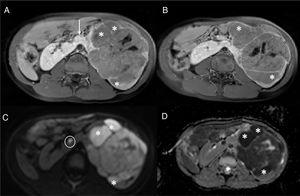 Paciente de 5 años de edad afectada de síndrome de Beckwith-Wiedemann. Un control ecográfico realizado 6 meses no mostró alteraciones. La RM abdominal detecta un nefroblastoma izquierdo y focos de RN/nefroblastomatosis bilaterales en un riñón en herradura. a y b) Secuencias ponderadas en T1 con supresión grasa y contraste intravenoso en el plano axial sobre los riñones. Se identifica un riñón en herradura con unión de riñones por delante de la aorta abdominal (flecha en a) y múltiples lesiones confluentes en el hemirriñón izquierdo (asteriscos en a y b) compatibles con RN/nefroblastomatosis. Destaca una de las lesiones de mayor tamaño, con características discretamente distintas, más heterogénea (línea punteada en b) compatible con nefroblastoma. c) Estudio de difusión en el plano axial, b 1.000. d) Mapa de ADC. Restricción a la difusión de las múltiples lesiones del hemirriñón izquierdo (asteriscos en c y d) y restricción ligeramente distinta, menor, de la lesión de mayor tamaño. Destaca la presencia de un foco milimétrico en el hemirriñón contralateral (círculo en c) con restricción a la difusión.