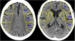 TC craneal sin contraste. En esta figura se observan los 10 puntos del ASPECTS, los 4 territorios profundos, la cabeza del núcleo caudado (C), la cápsula interna (CI), la ínsula (I) y el núcleo lenticular (L), y los 6 territorios superficiales de la arteria cerebral media (M1, M2, M3, M4, M5 y M6).