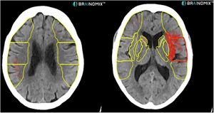 TC craneal sin contraste. En esta imagen se observa procesamiento automático del programa Brainomix que, en amarillo, marca los territorios de la arteria cerebral media que se valoran en la escala ASPECTS y en rojo, las zonas del parénquima afectadas (8 en este caso) en una paciente de 73 años con déficit completo de la arteria cerebral media izquierda.