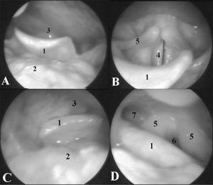 A. En un paciente con vía aérea normal se observa: 1) la epiglotis, 2) la base de la lengua, 3) la distancia hasta la pared posterior de la faringe es normal. B. Si se sigue introduciendo el laringoscopio en el mismo paciente se ve: 1) la epiglotis, 4) las cuerdas vocales, 5) los aritenoides. C. En el paciente con tumor de base de lengua se aprecia: 1) la epiglotis, 2) la base de la lengua, 3) que la distancia de la epiglotis hasta la parte posterior de la faringe estaba disminuida y no se pudo ver la glotis. D. En el paciente con carcinoma de amígdala, se ve: 1) la epiglotis, 5) los aritenoides con ligero edema, 6) el orificio de la glotis, 7) el seno piriforme.