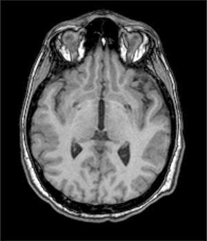 Imágenes en “ojo de tigre” en los núcleos pálidos en RMN.