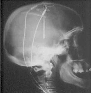 Radiografía de cráneo de perfil en la que se observa el sistema de estimulación cerebral profunda con los dos electrodos que llegan hasta ambos núcleos pálidos.