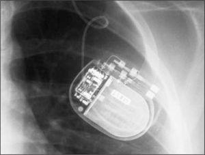 Radiografía de tórax en la que se observa el generador conectado al extremo distal de los electrodos cerebrales.