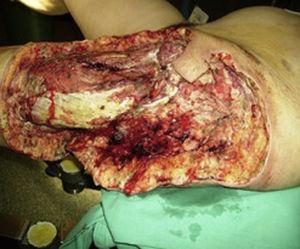 Imagen del miembro inferior izquierdo de la paciente. Puede observarse uno de los desbridamientos quirúrgicos de la herida infectada por mucormicosis, con la amplia destrucción tisular.