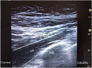 Bloqueo serrato-intercostal/BRILMA. Líneas: aguja. ICM: músculos intercostales; LA: anestésico local.