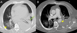(A) Imagen axial en ventana pulmonar de tomografía computarizada (TC) torácica en condiciones basales a nivel de aorta torácica descendente. Se aprecian opacidades en vidrio deslustrado bilaterales de predominio en lóbulos inferiores (flecha amarilla), asociadas a un área de consolidación/atelectasia con broncograma aéreo en el lóbulo inferior izquierdo (flecha alargada verde). Moderado-notable derrame pleural izquierdo. (B) Imagen axial en ventana mediastínica de angio-TC pulmonar. Destacan unos defectos de repleción en ramas lobar y segmentarias del lóbulo medio de la arteria pulmonar (flecha amarilla) compatibles con tromboembolismo pulmonar agudo. Moderado-notable derrame pleural izquierdo.