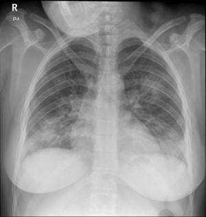 Radiografía posteroanterior de tórax: consolidaciones parenquimatosas bilaterales en campos pulmonares inferiores y medios, compatibles con neumonía vírica por COVID-19, dado el contexto epidémico.