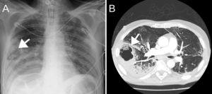 Radiografía de tórax portátil que evidencia posible cavitación pulmonar lóbulo inferior derecho (imagen A). TC tórax que muestra LID con posible neumonía necrotizante (imagen B). Ambas imágenes marcadas con una flecha.