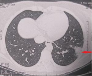TC torácica que muestra pequeña condensación alveolar (flecha roja) en el pulmón izquierdo.