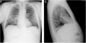 Radiografía simple de tórax (paciente 5). Infiltrados intersticiales bilaterales (proyecciones posteroanterior y lateral).