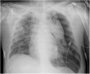 Radiografía de tórax (paciente 5). Opacidades en el pulmón derecho, neumotórax izquierdo masivo (previo a la inserción de drenaje), catéter en la vena yugular interna derecha.