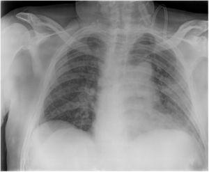 Radiografía simple de tórax (paciente 6). Opacidades pulmonares reticulares bilaterales.