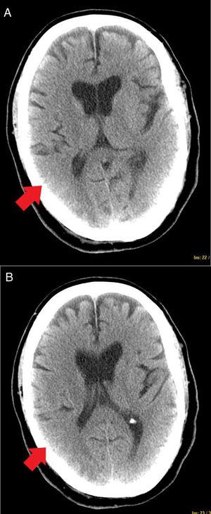 TAC cerebral. Lesiones hipodensas subcorticales parietooccipitales bilaterales de predominio derecho.