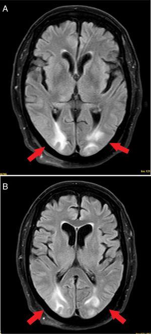RM cerebral en secuencia T2. Lesiones hiperintensas subcorticales en región parietooccipital bilateral indicativas de PRES.