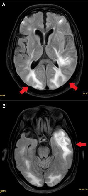 RM cerebral en secuencia T2. Lesiones hiperintensas supratentoriales en región occipital bilateral y temporal izquierda indicativas de PRES.