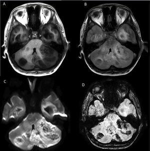 RM cerebral que muestra lesiones cerebelosas y temporales en T1 (A), hiperintensas en FLAIR (B) con edema vasogénico perilesional. Se observan lesiones heterogenéticas en DWI (C). En SWI (D), las lesiones son hipointensas, reflejando el componente hemorrágico de las lesiones.