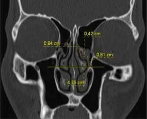 Proceso uncinado izquierdo con inserción superior en la concha nasal media (T1). La longitud es de 1,23cm y la orientación, medial con respecto a la línea media.