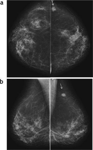 Mamografía en proyección (a) craneocaudal y (b) oblicua, donde se visualiza un nódulo denso de 1cm de diámetro, con bordes espiculados, en el cuadrante superoexterno-cola axilar izquierda (flecha).