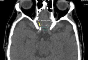 Localización y frecuencia de placas ateromatosas intracraneales en