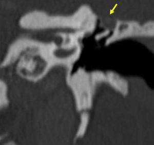 Tomografía computada de oído, corte coronal: colesteatoma de la pars flácida. Se observa una lesión con densidad de tejido blando ocupando el espacio de Prussak. Nótese el adelgazamiento del tegmen timpani (flecha).