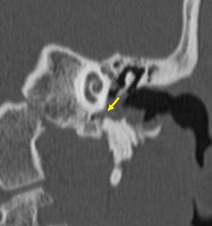Tomografía computada de oído, corte coronal: colesteatoma de la pars tensa. Se evidencia una lesión de tejido blando en el hipotímpano, ocupando el sinus timpani (flecha) (punto ciego en el examen otoscópico).