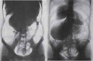 Neumoperitoneo diagnóstico mostrando patología renal. A la izquierda se observa un carcinoma renal y a la derecha, un quiste hidatídico renal21.