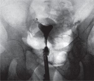 Ginecografía. La histerosalpingografía muestra la cavidad uterina normal completa con lipiodol, así como la trompa de Falopio derecha. El tubo de la izquierda se alarga, mientras el neumoperitoneo muestra el contorno del útero ligeramente agrandado y una masa redonda en el ovario izquierdo23.