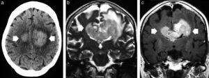 Linfoma primario de células B grandes del sistema nervioso central en un paciente inmunocompetente. La TC sin contraste muestra (a) una lesión espontáneamente hiperdensa que cruza el cuerpo calloso (flechas), mientras que (b) la secuencia ponderada en T2, en corte axial, confirma una lesión isointensa con respecto a la sustancia gris (flecha), que se distingue del edema vasogénico perilesional y es predominante en el hemisferio cerebral izquierdo. (c) La imagen axial en ponderación T1 después de la administración intravenosa de gadolinio evidencia un marcado realce de contraste homogéneo (flechas).